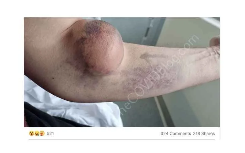 ΒΡΕΤΑΝΟΣ ΑΠΟΚΛΕΙΣΤΗΚΕ ΑΠΟ ΤΟ Facebook ΟΤΑΝ ΜΟΙΡΑΣΕ ΤΑ ΟΦΕΛΗ ΤΩΝ ΕΝΕΣΕΩΝ, ΤΟΥΣ ΘΡΟΜΒΟΥΣ ΣΤΟ ΧΕΡΙ ΤΟΥ, ΜΕΤΑ ΤΗΝ ΒΟΗΘΕΙΑ ΤΗΣ AstraZeneca.